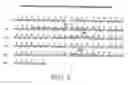 Fig. 10 - Neutralizing human antibodies to anthrax toxin