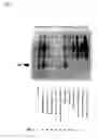 Fig. 04 - Method for detecting perilymphatic fistula