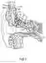 Fig. 02 - Implantable hearing aid actuator positioning