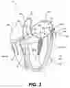 Fig. 06 - Devices and methods for heart valve treatment