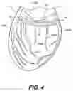 Fig. 07 - Devices and methods for heart valve treatment