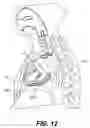 Fig. 30 - Devices and methods for heart valve treatment