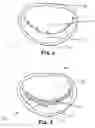 Fig. 02 - Mitral shield