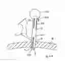 Fig. 100 - Apparatus for inserting a surgical device at least partially through a wound opening