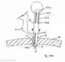 Fig. 99 - Apparatus for inserting a surgical device at least partially through a wound opening