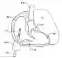 Fig. 01 - Magnetic navigation systems with dynamic mechanically manipulatable catheters