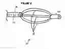 Fig. 03 - Echogenic markers on GI medical devices