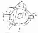 Fig. 04 - Echogenic markers on GI medical devices