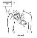 Fig. 02 - Implantable capacitive pressure sensor system and method