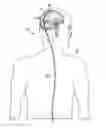 Fig. 01 - Implantable cerebral spinal fluid flow device and method of controlling flow of cerebral spinal fluid