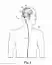 Fig. 02 - Implantable cerebral spinal fluid flow device and method of controlling flow of cerebral spinal fluid