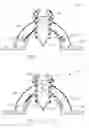 Fig. 09 - Intra-abdominal storage device