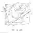 Fig. 30 - Intra-abdominal storage device