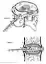 Fig. 07 - Treating back pain by re-establishing the exchange of nutrient and waste
