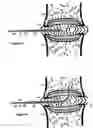 Fig. 19 - Treating back pain by re-establishing the exchange of nutrient and waste