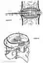 Fig. 20 - Treating back pain by re-establishing the exchange of nutrient and waste
