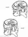 Fig. 31 - Treating back pain by re-establishing the exchange of nutrient and waste