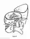 Fig. 32 - Treating back pain by re-establishing the exchange of nutrient and waste