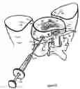 Fig. 35 - Treating back pain by re-establishing the exchange of nutrient and waste