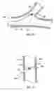 Fig. 12 - Medical device with procedure improvement features