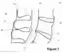 Fig. 02 - Spinous Process Spacer Implant and Technique