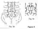 Fig. 04 - Spinous Process Spacer Implant and Technique