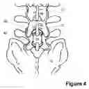 Fig. 05 - Spinous Process Spacer Implant and Technique