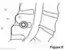 Fig. 07 - Spinous Process Spacer Implant and Technique