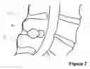Fig. 08 - Spinous Process Spacer Implant and Technique