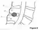Fig. 09 - Spinous Process Spacer Implant and Technique