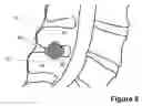 Fig. 10 - Spinous Process Spacer Implant and Technique