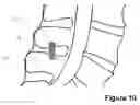 Fig. 11 - Spinous Process Spacer Implant and Technique