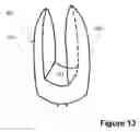 Fig. 14 - Spinous Process Spacer Implant and Technique