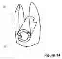 Fig. 15 - Spinous Process Spacer Implant and Technique