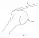 Fig. 02 - Method and apparatus for the repair of a rotator cuff (RTC) tendon or ligament