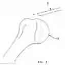 Fig. 03 - Method and apparatus for the repair of a rotator cuff (RTC) tendon or ligament