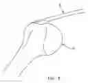 Fig. 04 - Method and apparatus for the repair of a rotator cuff (RTC) tendon or ligament