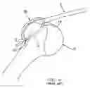 Fig. 05 - Method and apparatus for the repair of a rotator cuff (RTC) tendon or ligament