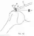 Fig. 10 - Method and apparatus for the repair of a rotator cuff (RTC) tendon or ligament