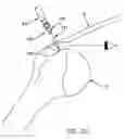 Fig. 17 - Method and apparatus for the repair of a rotator cuff (RTC) tendon or ligament