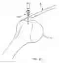 Fig. 18 - Method and apparatus for the repair of a rotator cuff (RTC) tendon or ligament