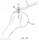 Fig. 19 - Method and apparatus for the repair of a rotator cuff (RTC) tendon or ligament