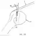 Fig. 20 - Method and apparatus for the repair of a rotator cuff (RTC) tendon or ligament