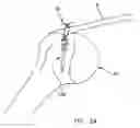 Fig. 21 - Method and apparatus for the repair of a rotator cuff (RTC) tendon or ligament