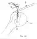 Fig. 22 - Method and apparatus for the repair of a rotator cuff (RTC) tendon or ligament