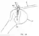 Fig. 23 - Method and apparatus for the repair of a rotator cuff (RTC) tendon or ligament