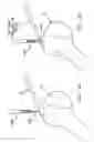 Fig. 31 - Method and apparatus for the repair of a rotator cuff (RTC) tendon or ligament