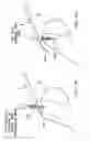 Fig. 32 - Method and apparatus for the repair of a rotator cuff (RTC) tendon or ligament