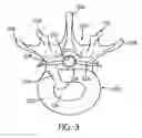 Fig. 03 - Disc annulus repair system