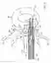 Fig. 12 - Disc annulus repair system